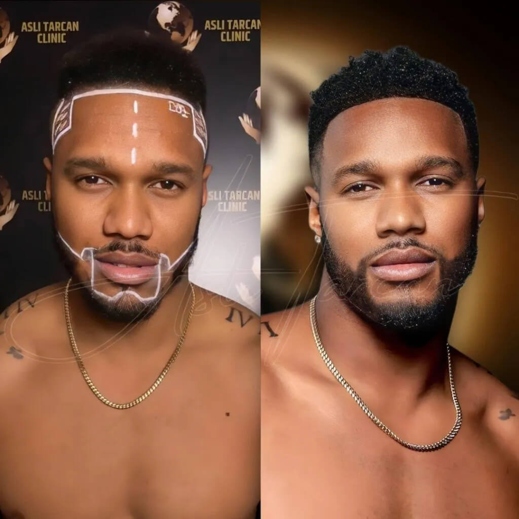 Afro Hair Transplant before and after
