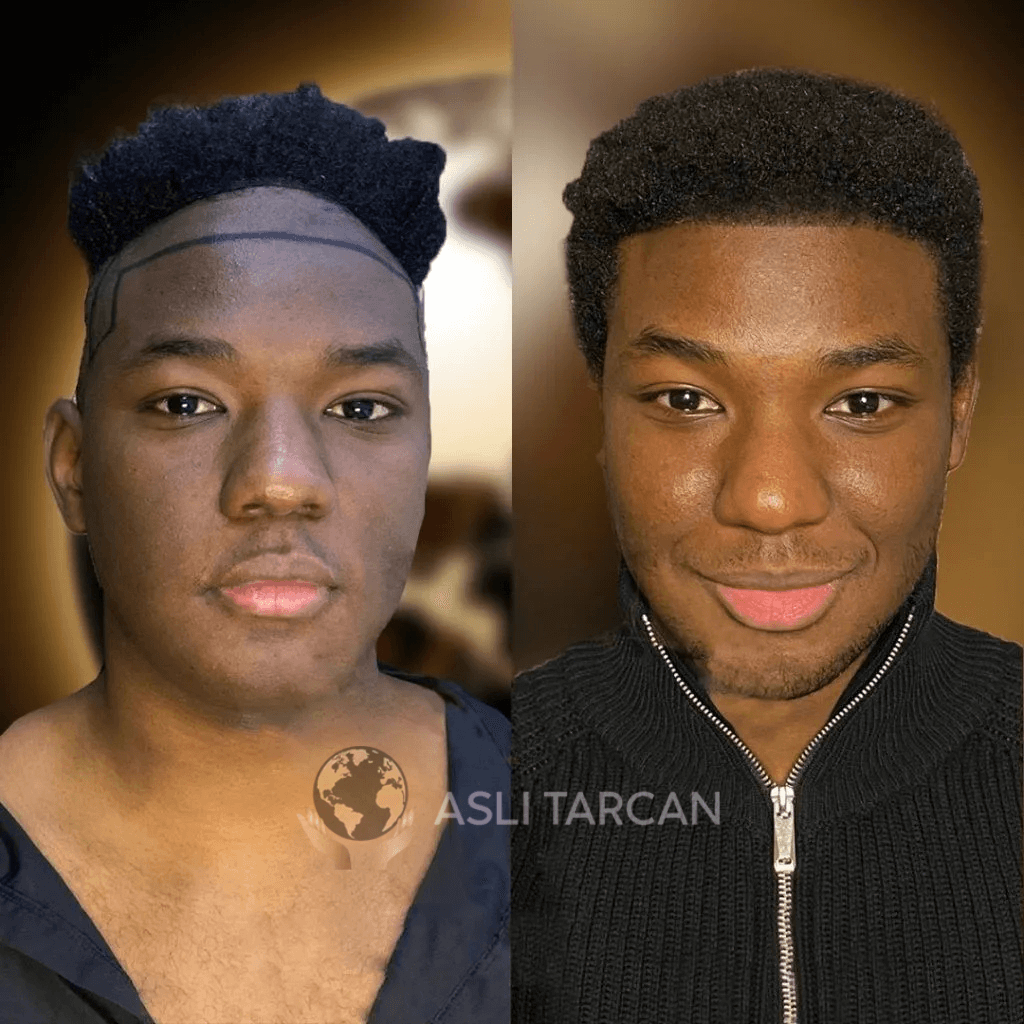 Afro Hair transplant before and after with Asli Tarcan