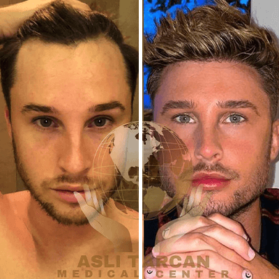 Hair transplant Turkey before and after