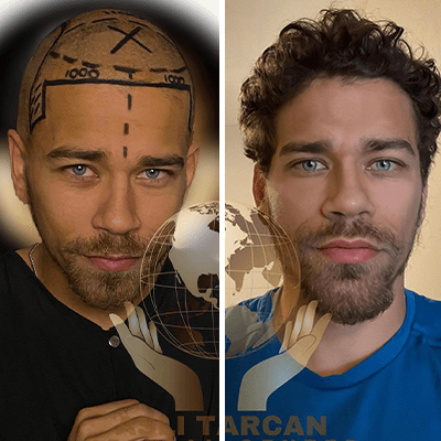 Hair transplant Turkey before and after