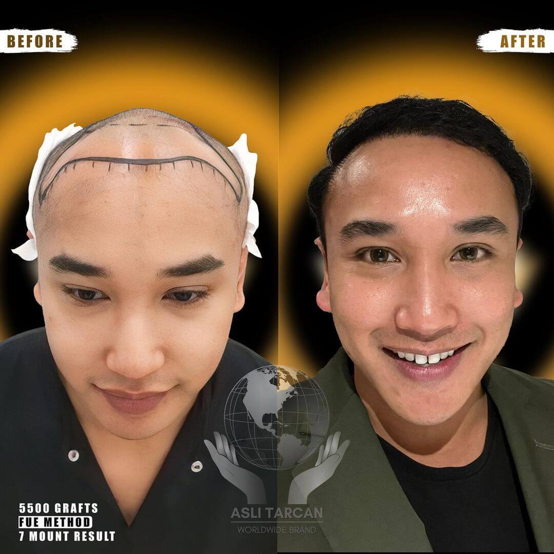 Hair transplant Turkey before and after_5500 Grafts