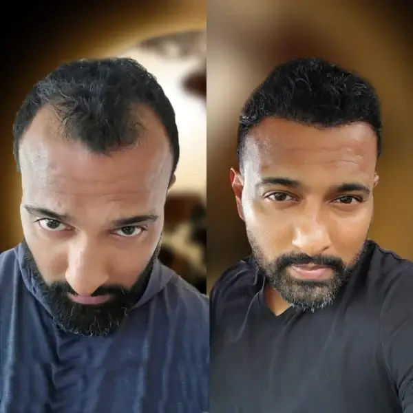 Hair transplant Turkey result