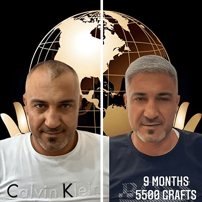Hair transplant before and after result