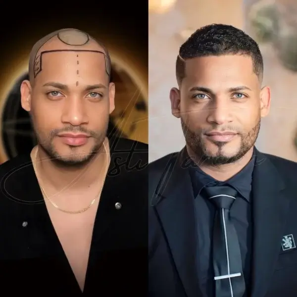 Hair transplant before and after result