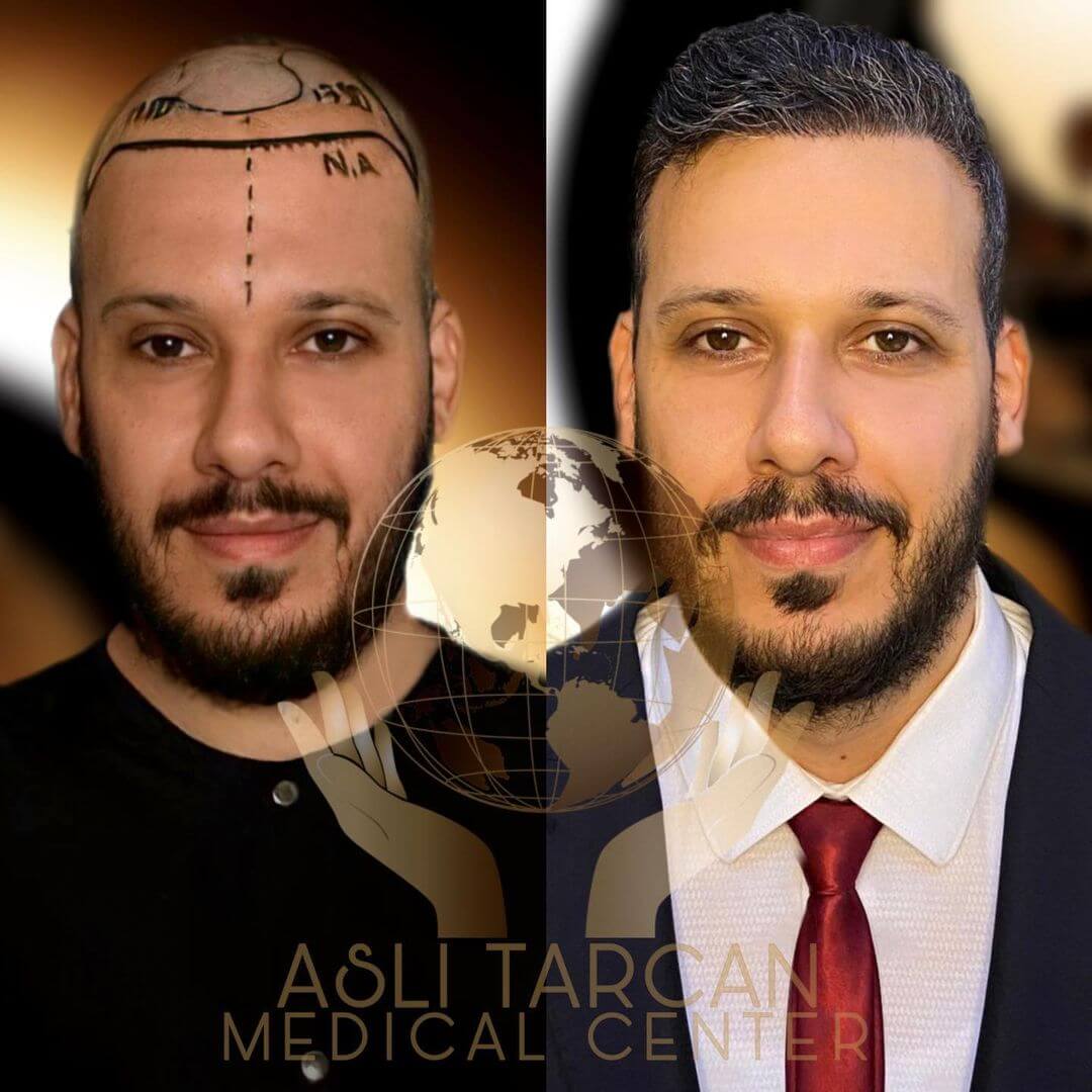 Hair transplant turkey before & after