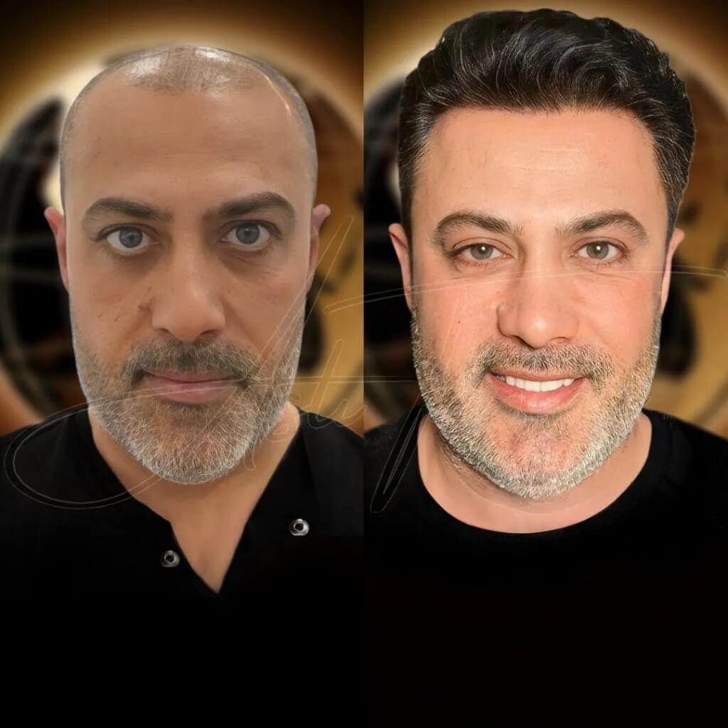 Turkey Hair transplant before and after