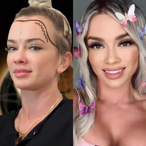 hair transplant for women before and after