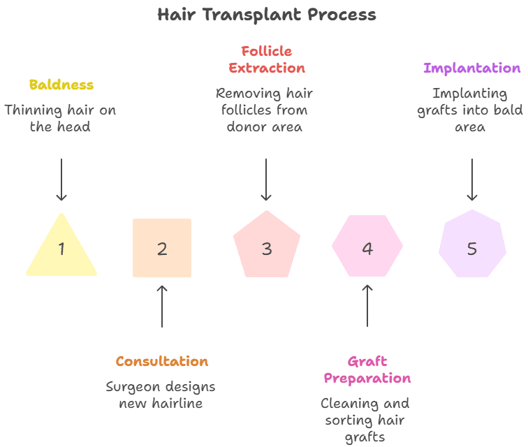 Infographic showing the hair transplant process in five steps: 1. Baldness – thinning hair on the head, 2. Consultation – surgeon designs new hairline, 3. Follicle Extraction – removing hair follicles from donor area, 4. Graft Preparation – cleaning and sorting hair grafts, 5. Implantation – implanting grafts into bald area.